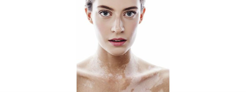 Vitiligo patches affecting chest, skin, conditions, Harley Street Emporium 