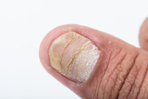 psoriasis affecting the nail