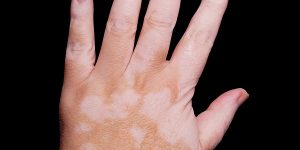 vitiligo-2-rect
