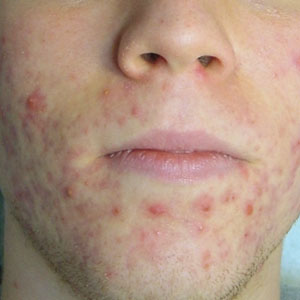 plexr-acne-after-treatments-harley-street-emporium