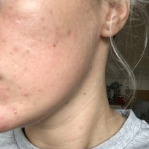 acne-scars-after-solution-for-scars