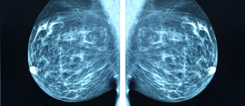 mammogram-harley-street-emporium